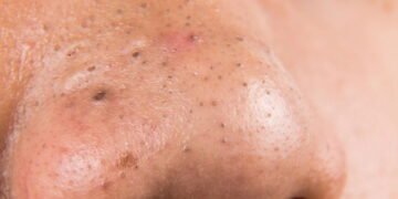 Entenda o surgimento dos cravos e como evitá-los com facilidade