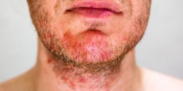 Sofrendo com foliculite? Veja como aliviar com métodos caseiros