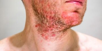 Sofrendo com foliculite? Veja como aliviar com métodos caseiros