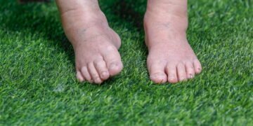 Retenção de líquidos no verão? Veja como evitar o inchaço nos dias quentes