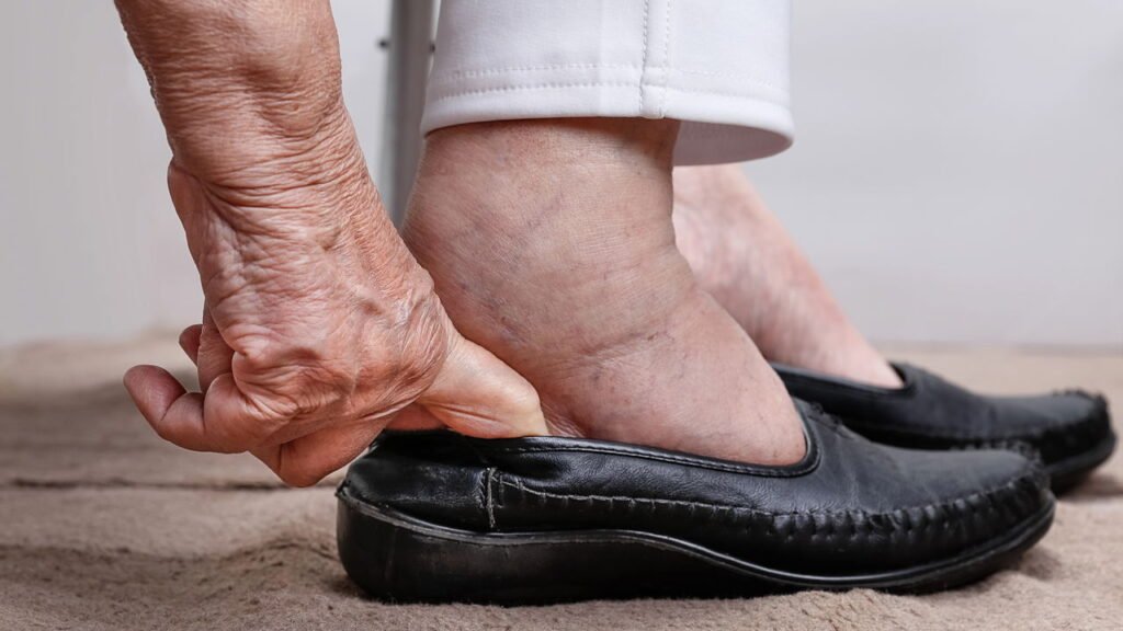 Retenção de líquidos no verão? Veja como evitar o inchaço nos dias quentes