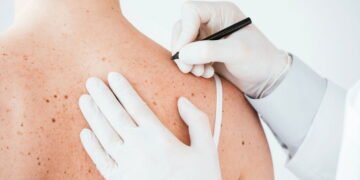 Você sofre com bacne? Veja como alimentação e hormônios influenciam e como tratar