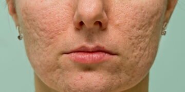 Os cuidados essenciais para evitar acne causada por maquiagem