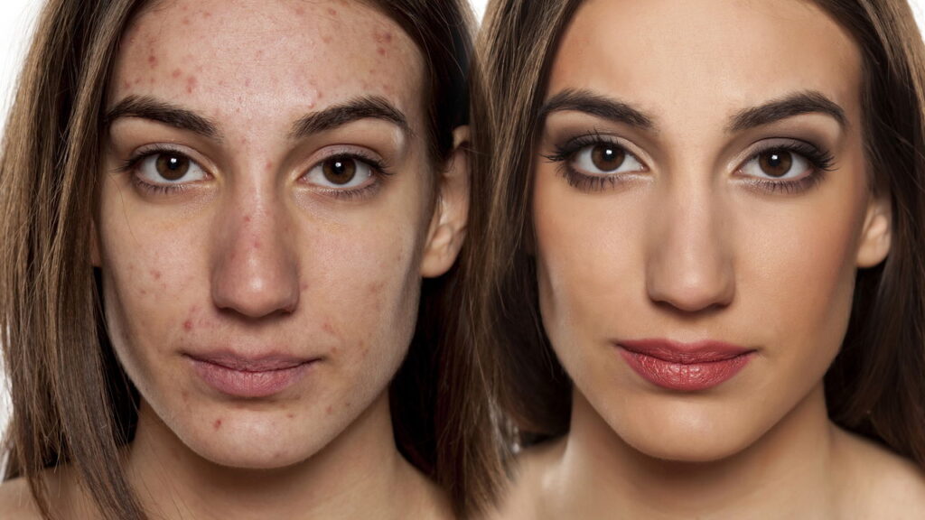 Os cuidados essenciais para evitar acne causada por maquiagem