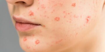 Cuidados essenciais ao usar tratamentos caseiros para espinhas