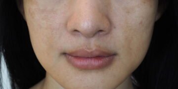 Essa mistura caseira está viralizando entre quem tem manchas escuras na pele