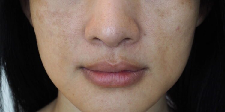 Mancha escura - Créditos: depositphotos.com / Mr.Note19