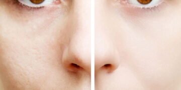 O simples truque para reduzir poros e melhorar a textura da pele