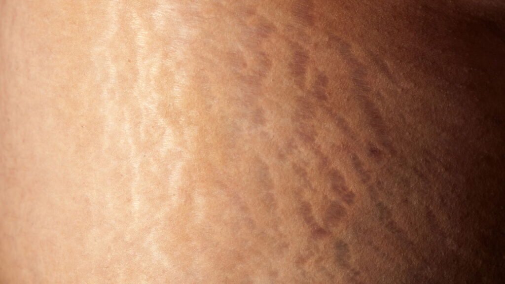 As principais causas das estrias e o que realmente funciona para tratá-las