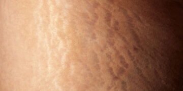 As principais causas das estrias e o que realmente funciona para tratá-las