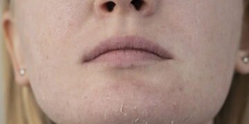 Como salvar sua pele do ressecamento do inverno sem gastar uma fortuna