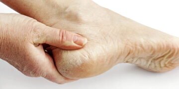 O hábito que poucos conhecem e que cura rachaduras nos pés rapidamente