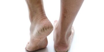 O hábito que poucos conhecem e que cura rachaduras nos pés rapidamente