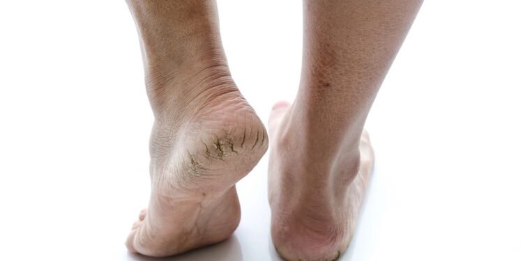 Rachadura no pé - Créditos: depositphotos.com / lufimorgan