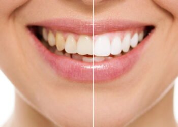 Dentistas alertam sobre moda do clareamento caseiro que viralizou nas redes