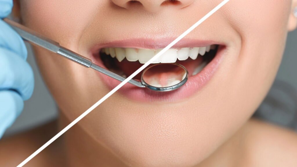 Dentistas alertam sobre moda do clareamento caseiro que viralizou nas redes