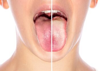 Comparação entre língua com e sem placa