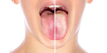 Comparação entre língua com e sem placa