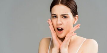 Espinhas no rosto? Todos os remédios naturais e econômicos que você pode encontrar na sua cozinha