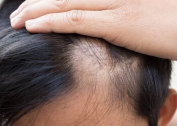 Homem com queda de cabelo aparente