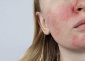 O que muda na pele depois dos 25 e por que isso causa acne e rosácea