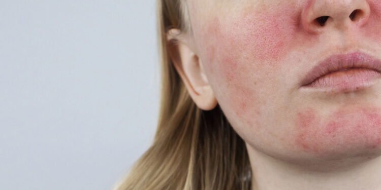 Existem diferentes tipos de rosácea, desde quadros com apenas vermelhidão  - Créditos: depositphotos.com / Alena1919
