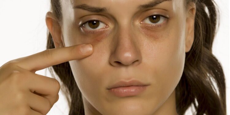 Olheiras - Créditos: depositphotos.com / VGeorgiev