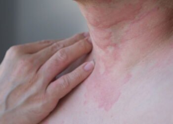 Saiba se proteger da doença que demora até 2 anos para ter diagnóstico no Brasil