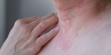 Saiba se proteger da doença que demora até 2 anos para ter diagnóstico no Brasil