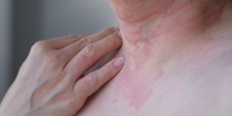 Saiba se proteger da doença que demora até 2 anos para ter diagnóstico no Brasil