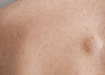 Dr. Patrizio Morisson, Cirurgião: não confunda esta gordura com um tumor