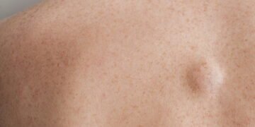 Dr. Patrizio Morisson, Cirurgião: não confunda esta gordura com um tumor