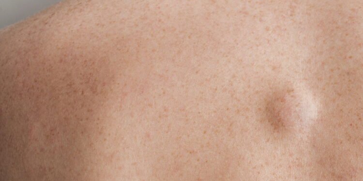 Lipoma - Créditos: depositphotos.com / cristianstorto