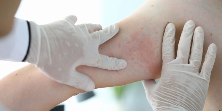 Dermatologista alerta sobre “Essas bolinhas na pele podem ser pele de galinha”