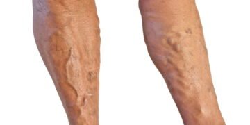 Dra. Andréa Klepacz, Cirurgiã Vascular: melhor época para tratar varizes? O inverno!