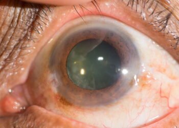 Dr. Fabio Medina, oftalmologista: desvende os segredos da cirurgia de Catarata