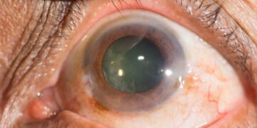 Dr. Fabio Medina, oftalmologista: desvende os segredos da cirurgia de Catarata