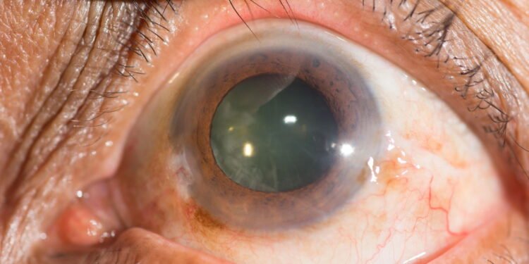 catarata - Créditos: depositphotos.com / arztsamui