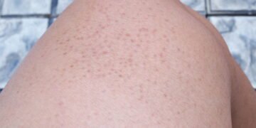 Dra. Natasha Crepaldi, dermatologista: “Essas bolinhas na pele podem ser pele de galinha”