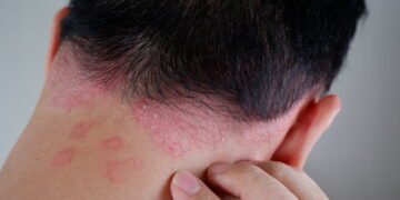 5 remédios caseiros para psoríase que você tem na sua casa