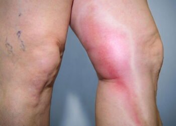 Dra. Andréa Klepacz, Cirurgiã Vascular: O que é Trombose? Entenda riscos e sintomas