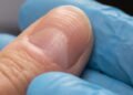 Se suas unhas têm essas linhas, atenção com sua saúde