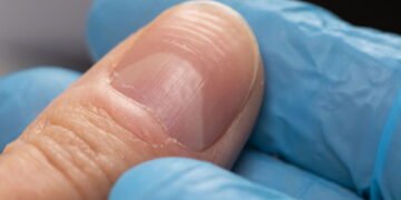 Se suas unhas têm essas linhas, atenção com sua saúde