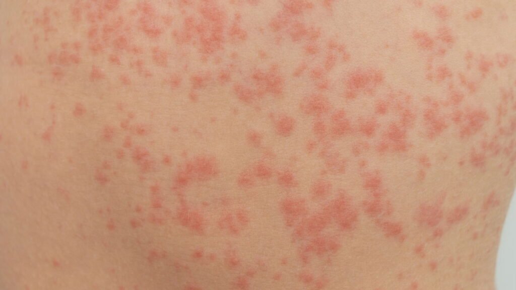 Saiba como identificar alergias alimentares em crianças de forma rápida e fácil através da pele