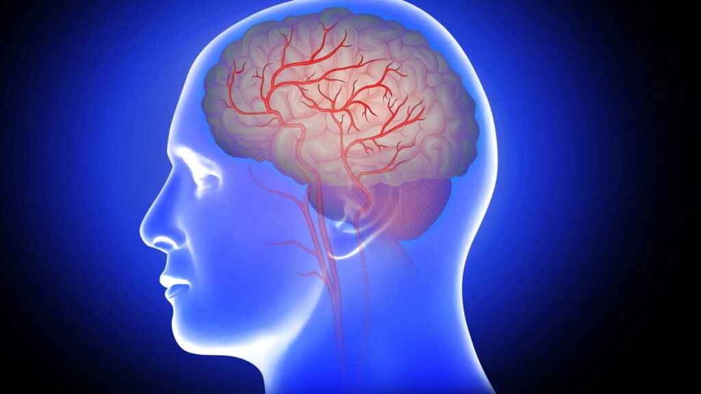Pessoas com fibrilação atrial são mais suscetíveis a derrame do que outras