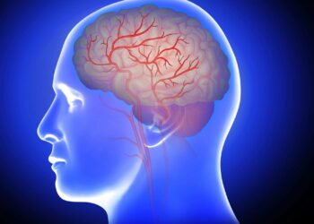 Pessoas com fibrilação atrial são mais suscetíveis a derrame do que outras