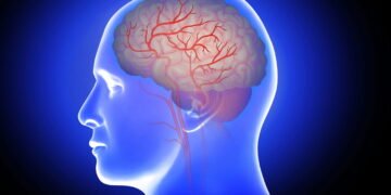 Pessoas com fibrilação atrial são mais suscetíveis a derrame do que outras