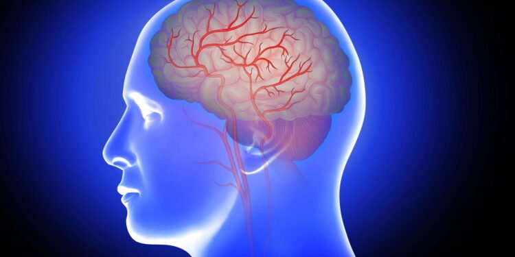 Pessoas com fibrilação atrial são mais suscetíveis a derrame do que outras