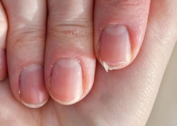 Unhas quebradiças? Esse banho nutritivo feito em casa resolve seu problema