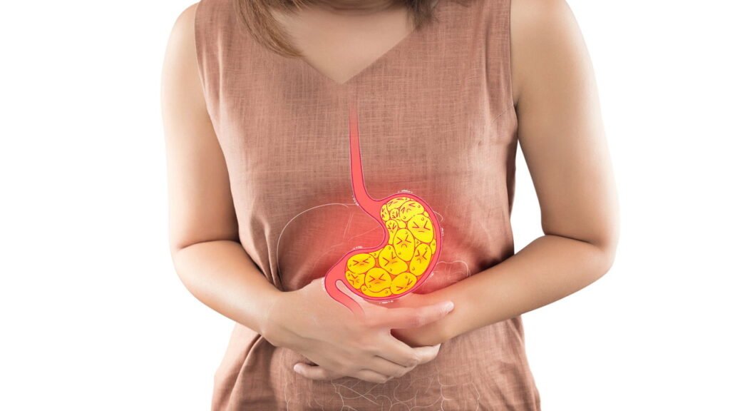 Gastroenterologista diz que 'mascar chiclete sem açúcar após as refeições e dormir à esquerda' reduz a azia